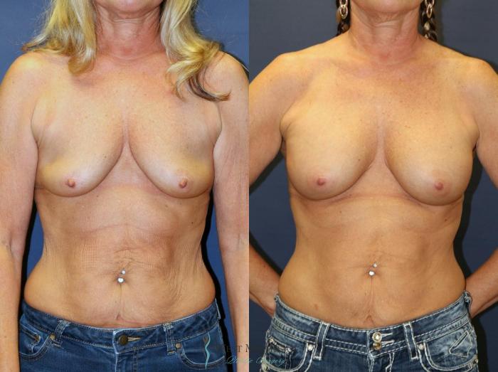 Before & After Breast Augmentation Case 9079 View #1 View in Kalamazoo & Grand Rapids, Michigan