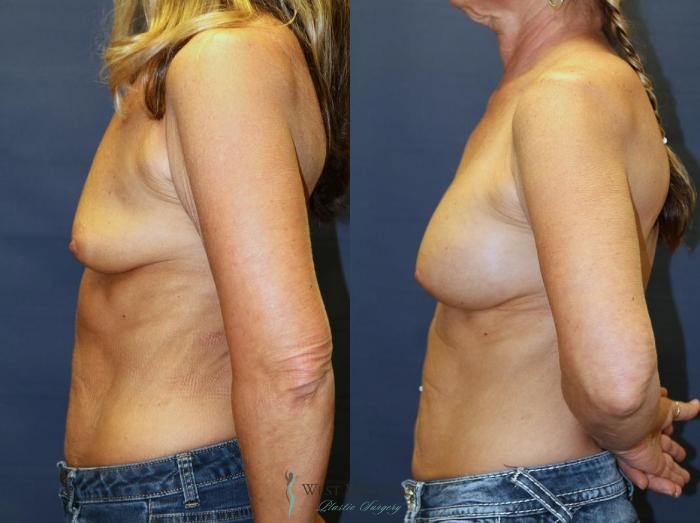 Before & After Breast Augmentation Case 9079 View #2 View in Kalamazoo & Grand Rapids, Michigan