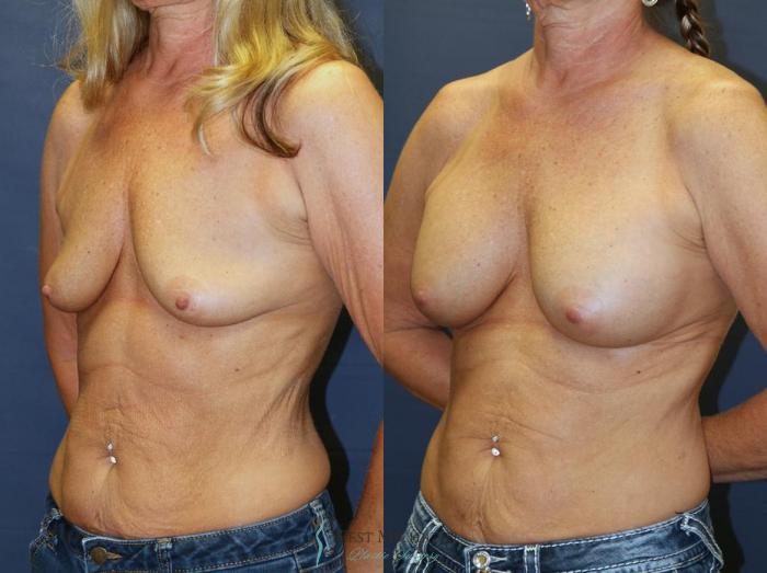 Before & After Breast Augmentation Case 9079 View #3 View in Kalamazoo & Grand Rapids, Michigan