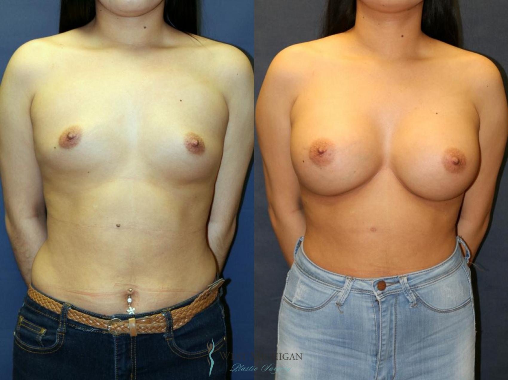 Before & After Breast Augmentation Case 9080 View #1 View in Kalamazoo & Grand Rapids, Michigan