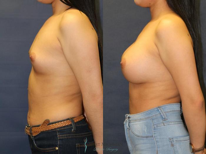 Before & After Breast Augmentation Case 9080 View #2 View in Kalamazoo & Grand Rapids, Michigan