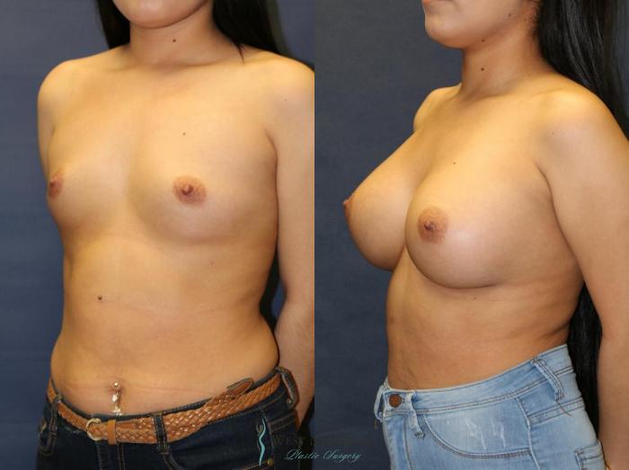 Before & After Breast Augmentation Case 9080 View #3 View in Kalamazoo & Grand Rapids, Michigan