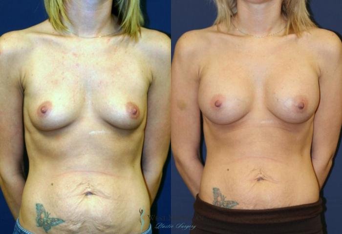 Before & After Breast Augmentation Case 9081 View #1 View in Portage, Kalamazoo, Battle Creek, Michigan
