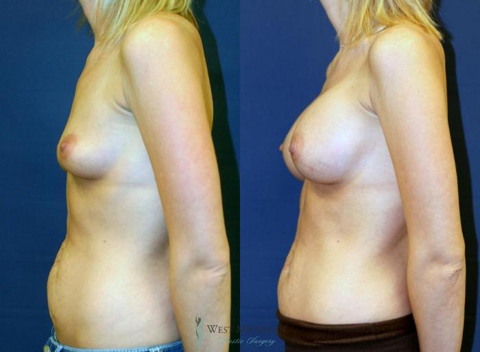 Before & After Breast Augmentation Case 9081 View #2 View in Portage, Kalamazoo, Battle Creek, Michigan
