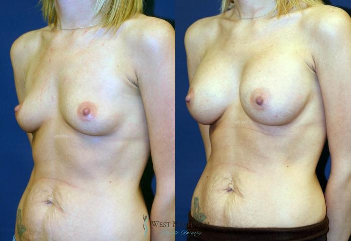 Before & After Breast Augmentation Case 9081 View #3 View in Portage, Kalamazoo, Battle Creek, Michigan