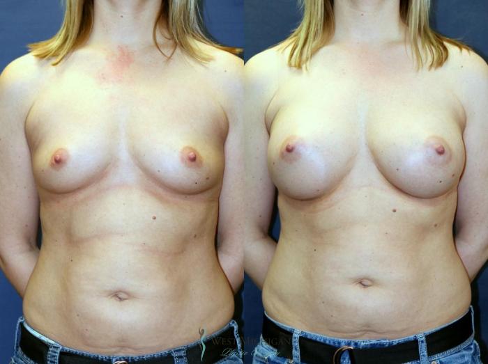 Before & After Breast Augmentation Case 9082 View #1 View in Kalamazoo & Grand Rapids, Michigan