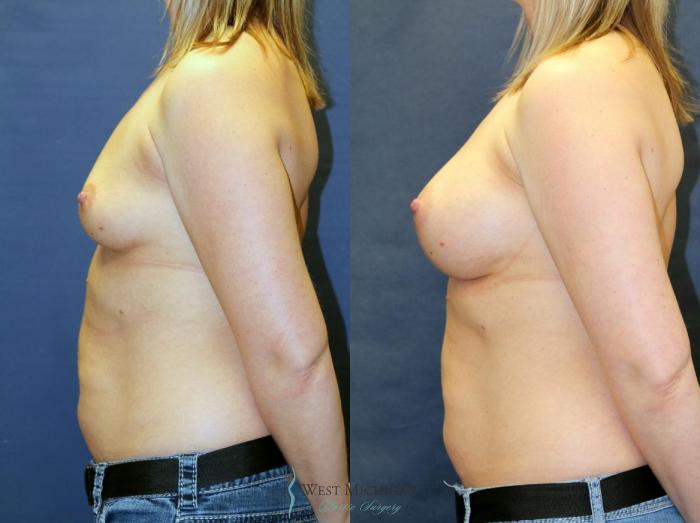 Before & After Breast Augmentation Case 9082 View #2 View in Kalamazoo & Grand Rapids, Michigan