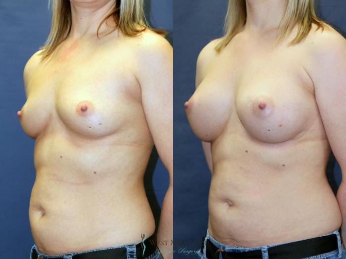 Before & After Breast Augmentation Case 9082 View #3 View in Kalamazoo & Grand Rapids, Michigan