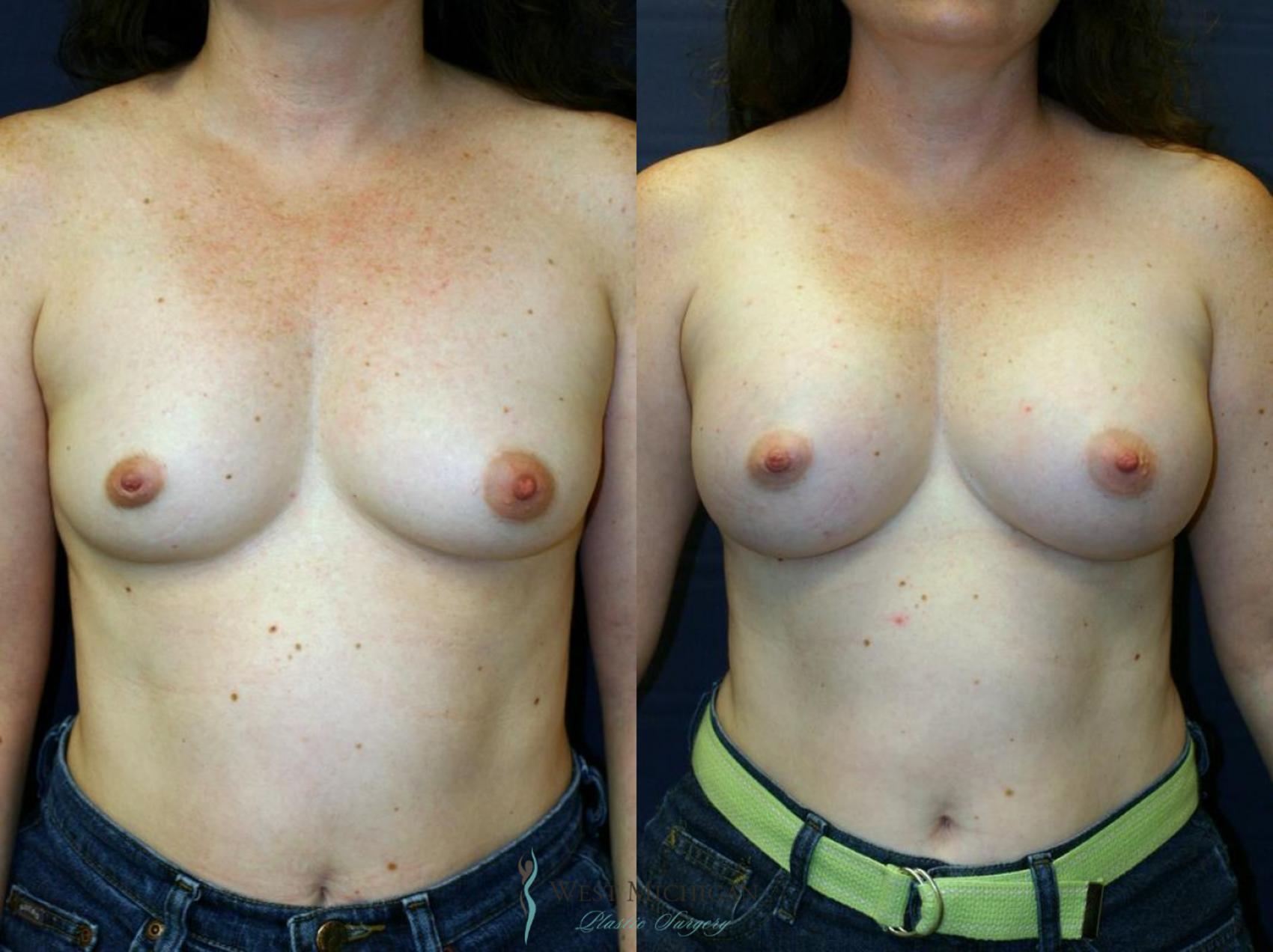 Before & After Breast Augmentation Case 9083 View #1 View in Portage, Kalamazoo, Battle Creek, Michigan