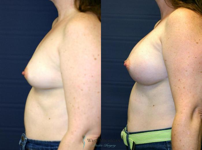Before & After Breast Augmentation Case 9083 View #2 View in Kalamazoo & Grand Rapids, Michigan