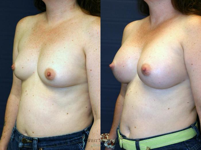 Before & After Breast Augmentation Case 9083 View #3 View in Kalamazoo & Grand Rapids, Michigan