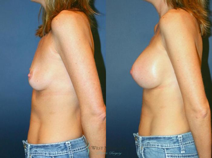 Before & After Breast Augmentation Case 9084 View #2 View in Kalamazoo & Grand Rapids, Michigan