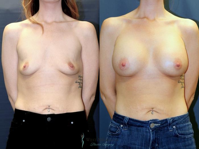 Before & After Breast Augmentation Case 9085 View #1 View in Kalamazoo & Grand Rapids, Michigan