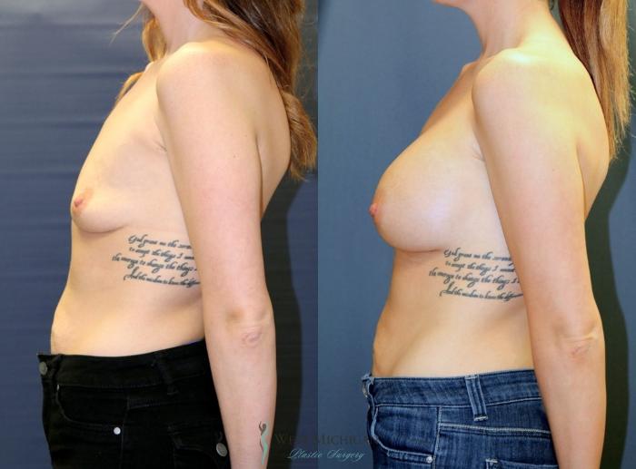 Before & After Breast Augmentation Case 9085 View #2 View in Kalamazoo & Grand Rapids, Michigan