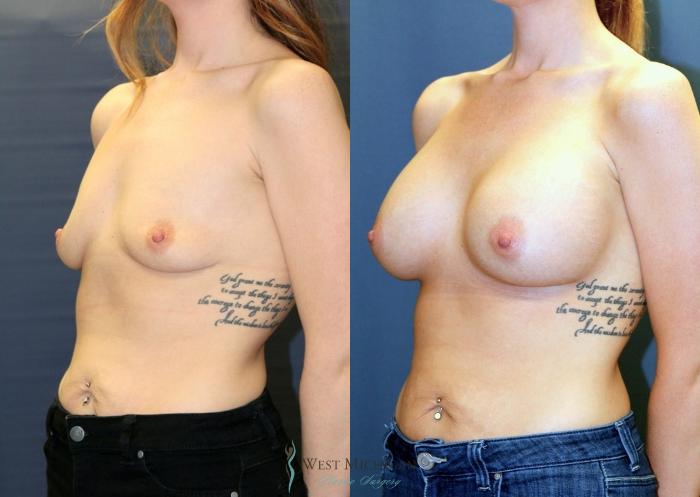 Before & After Breast Augmentation Case 9085 View #3 View in Kalamazoo & Grand Rapids, Michigan