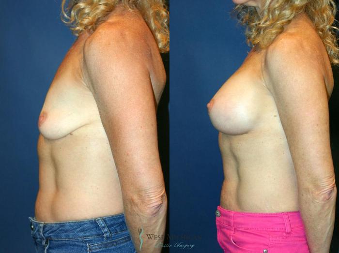 Before & After Breast Augmentation Case 9086 View #2 View in Kalamazoo & Grand Rapids, Michigan