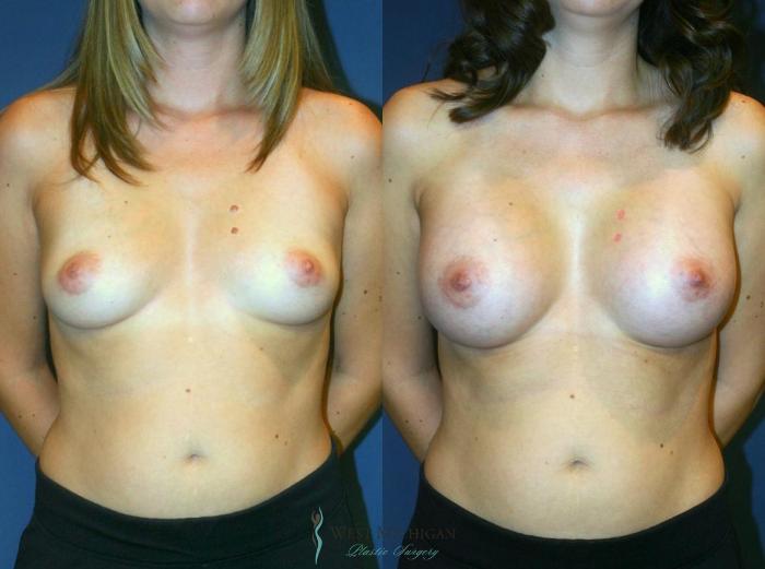 Before & After Breast Augmentation Case 9088 View #1 View in Kalamazoo & Grand Rapids, Michigan