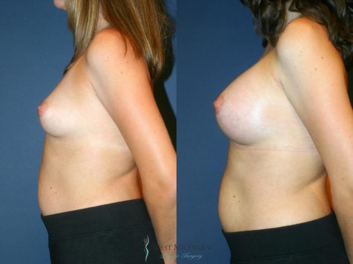 Before & After Breast Augmentation Case 9088 View #2 View in Kalamazoo & Grand Rapids, Michigan