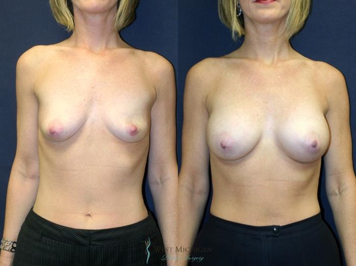 Before & After Breast Augmentation Case 9089 View #1 View in Kalamazoo & Grand Rapids, Michigan