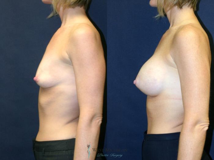 Before & After Breast Augmentation Case 9089 View #2 View in Kalamazoo & Grand Rapids, Michigan