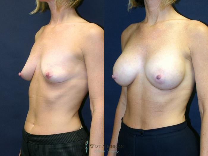 Before & After Breast Augmentation Case 9089 View #3 View in Kalamazoo & Grand Rapids, Michigan