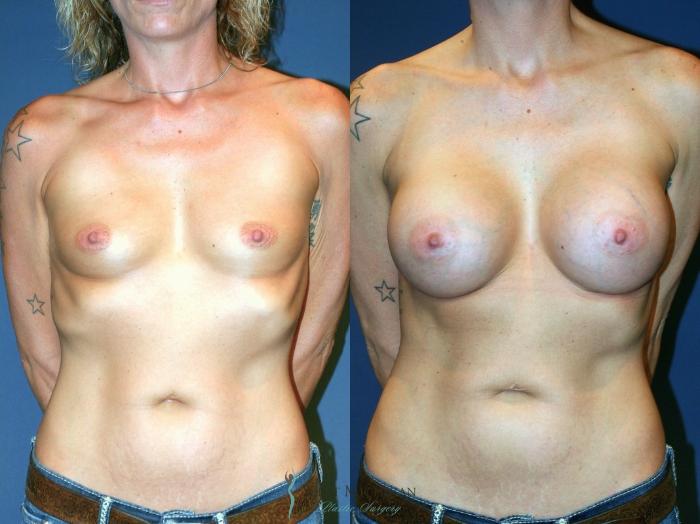 Before & After Breast Augmentation Case 9091 View #1 View in Kalamazoo & Grand Rapids, Michigan