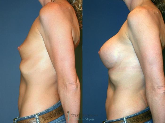 Before & After Breast Augmentation Case 9091 View #2 View in Kalamazoo & Grand Rapids, Michigan