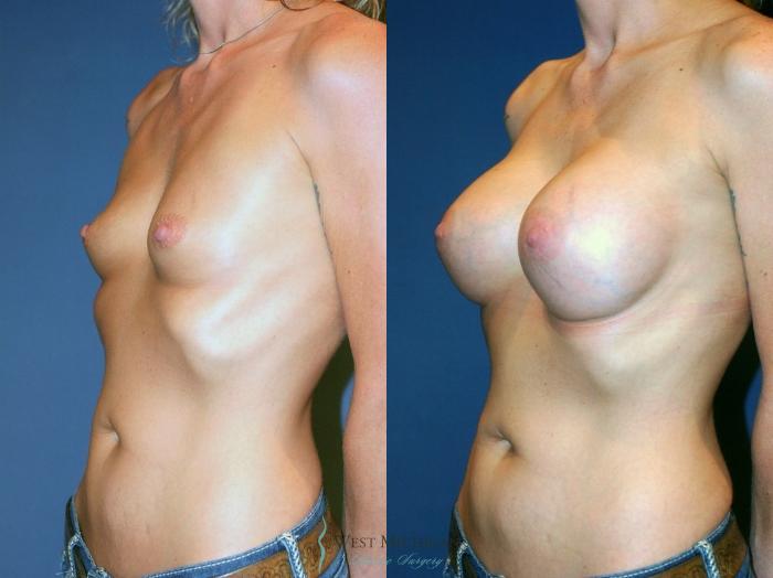 Before & After Breast Augmentation Case 9091 View #3 View in Kalamazoo & Grand Rapids, Michigan