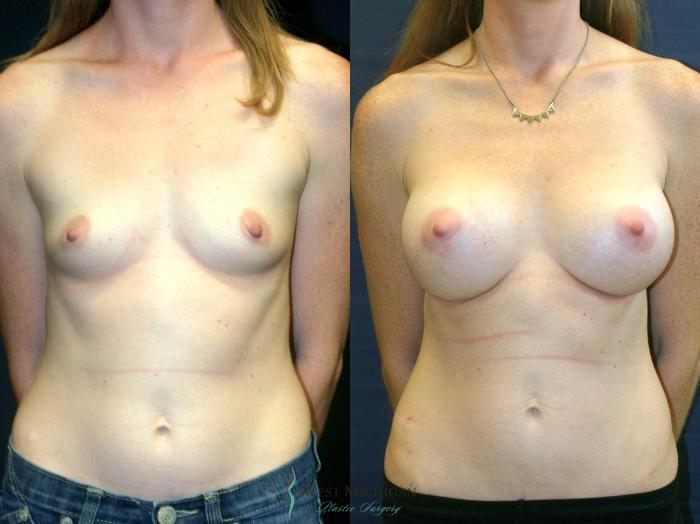 Before & After Breast Augmentation Case 9092 View #1 View in Kalamazoo & Grand Rapids, Michigan