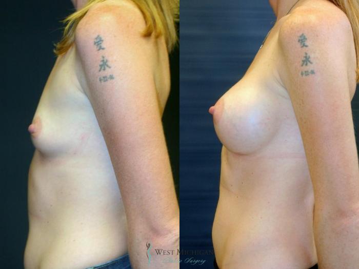 Before & After Breast Augmentation Case 9092 View #2 View in Kalamazoo & Grand Rapids, Michigan