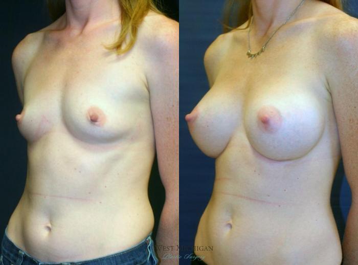 Before & After Breast Augmentation Case 9092 View #3 View in Kalamazoo & Grand Rapids, Michigan
