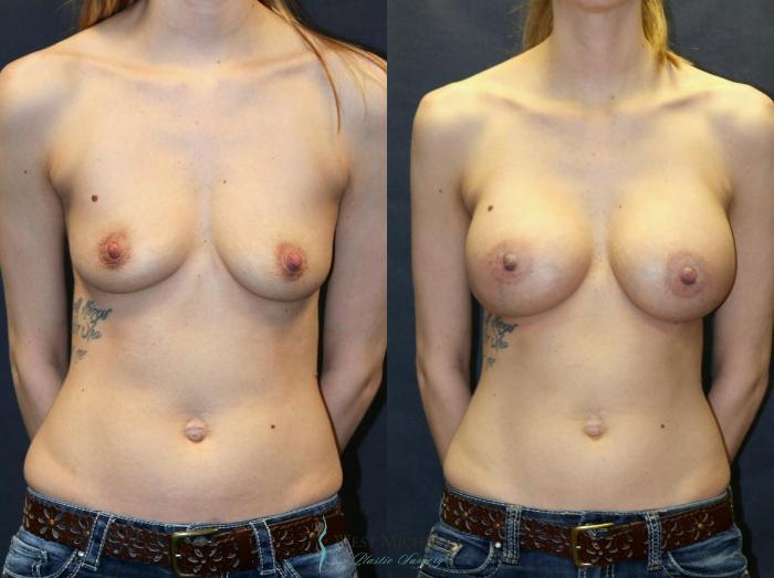 Before & After Breast Augmentation Case 9093 View #1 View in Portage, Kalamazoo, Battle Creek, Michigan