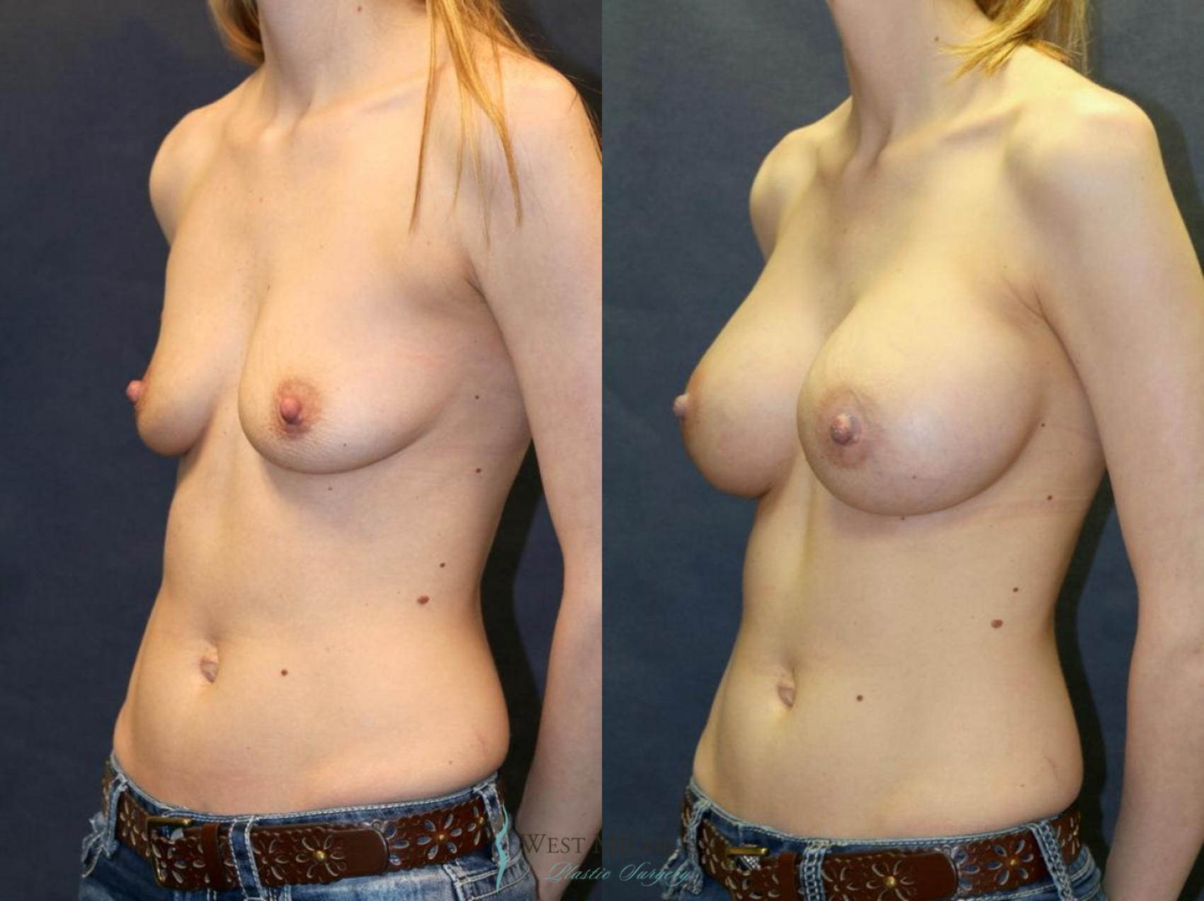 Before & After Breast Augmentation Case 9093 View #3 View in Portage, Kalamazoo, Battle Creek, Michigan