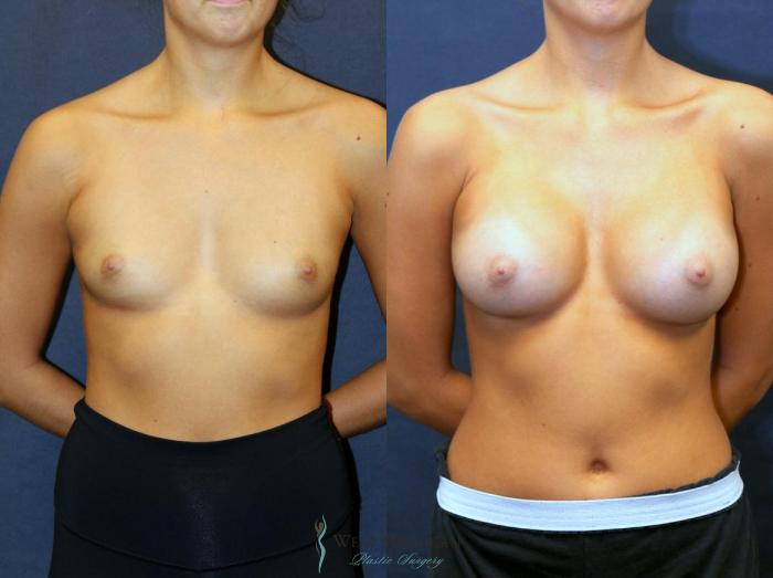 Before & After Breast Augmentation Case 9094 View #1 View in Kalamazoo & Grand Rapids, Michigan