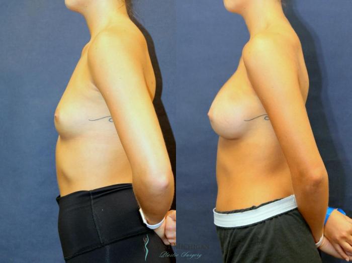 Before & After Breast Augmentation Case 9094 View #2 View in Kalamazoo & Grand Rapids, Michigan