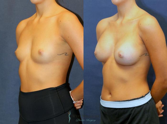 Before & After Breast Augmentation Case 9094 View #3 View in Kalamazoo & Grand Rapids, Michigan