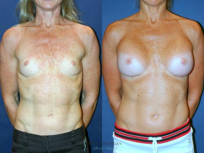 Before & After Breast Augmentation Case 9095 View #1 View in Kalamazoo & Grand Rapids, Michigan