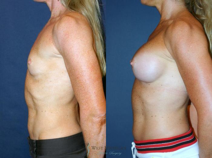 Before & After Breast Augmentation Case 9095 View #2 View in Kalamazoo & Grand Rapids, Michigan