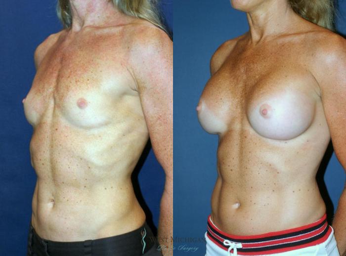 Before & After Breast Augmentation Case 9095 View #3 View in Kalamazoo & Grand Rapids, Michigan