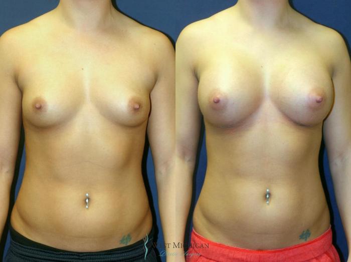 Before & After Breast Augmentation Case 9096 View #1 View in Portage, Kalamazoo, Battle Creek, Michigan