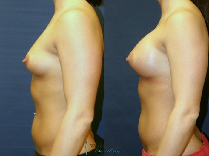 Before & After Breast Augmentation Case 9096 View #2 View in Portage, Kalamazoo, Battle Creek, Michigan