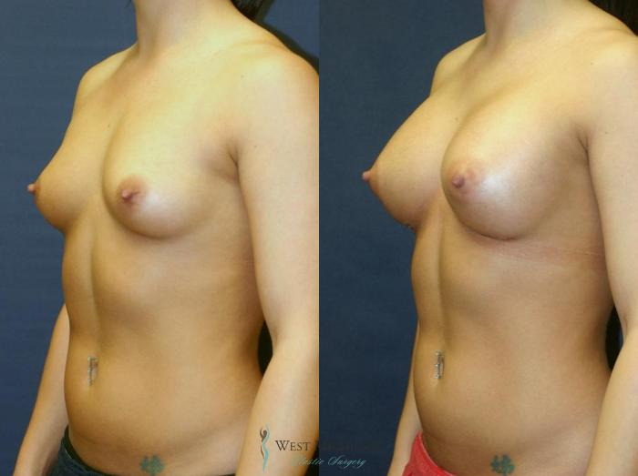 Before & After Breast Augmentation Case 9096 View #3 View in Portage, Kalamazoo, Battle Creek, Michigan