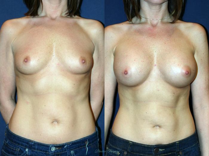 Before & After Breast Augmentation Case 9097 View #1 View in Kalamazoo & Grand Rapids, Michigan