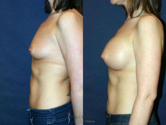 Before & After Breast Augmentation Case 9097 View #2 View in Kalamazoo & Grand Rapids, Michigan