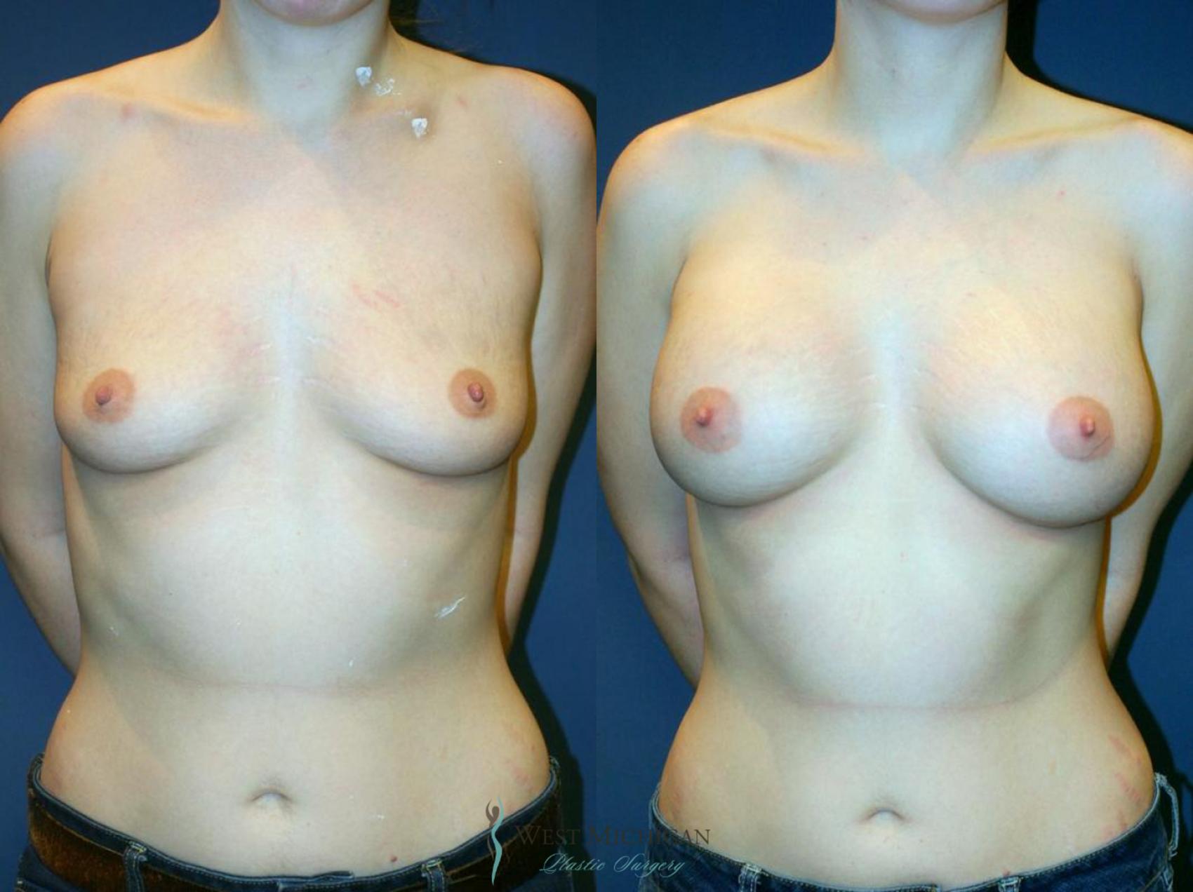 Before & After Breast Augmentation Case 9098 View #1 View in Portage, Kalamazoo, Battle Creek, Michigan