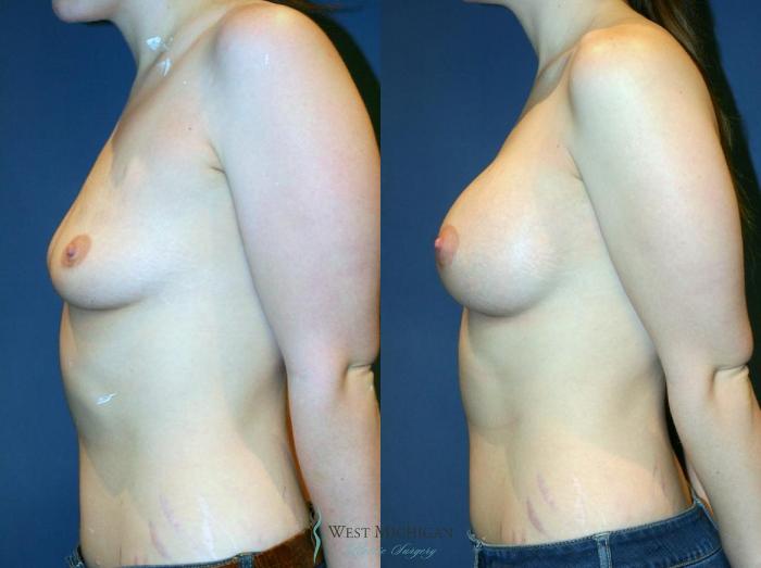 Before & After Breast Augmentation Case 9098 View #2 View in Portage, Kalamazoo, Battle Creek, Michigan