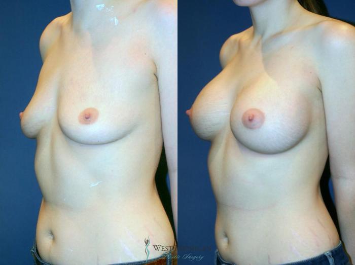 Before & After Breast Augmentation Case 9098 View #3 View in Portage, Kalamazoo, Battle Creek, Michigan