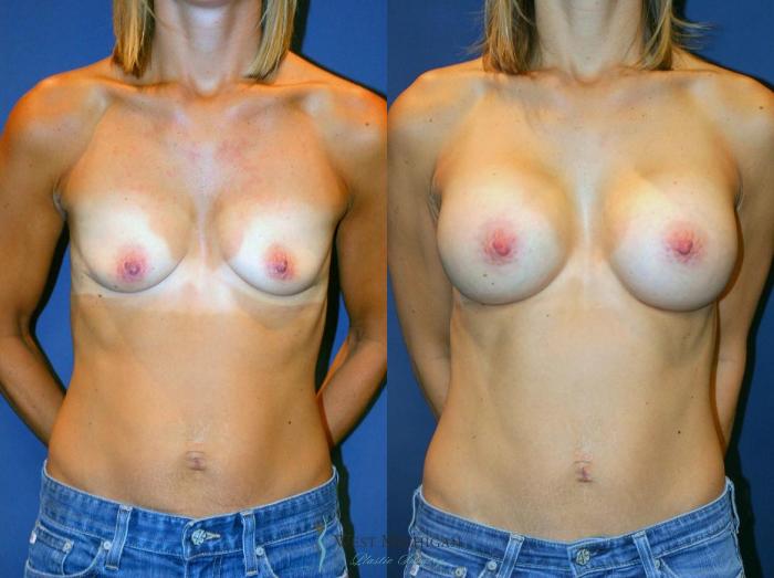 Before & After Breast Augmentation Case 9099 View #1 View in Kalamazoo & Grand Rapids, Michigan