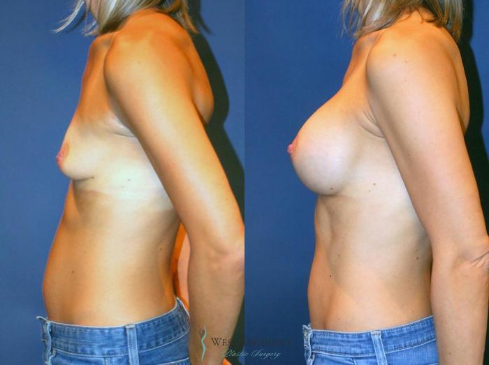 Before & After Breast Augmentation Case 9099 View #2 View in Kalamazoo & Grand Rapids, Michigan