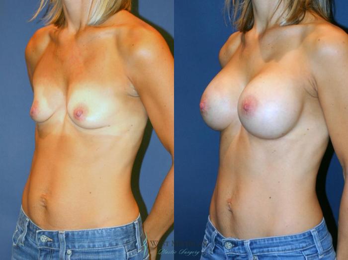 Before & After Breast Augmentation Case 9099 View #3 View in Kalamazoo & Grand Rapids, Michigan